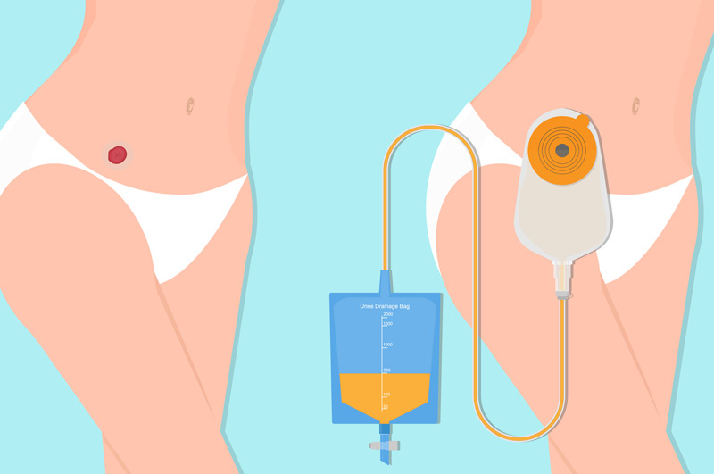 Illustration-of-potential-urinary-stoma-complications