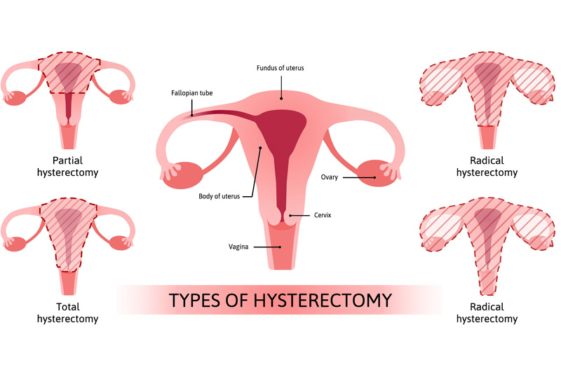 Illustration-of-types-of-hysterectomy